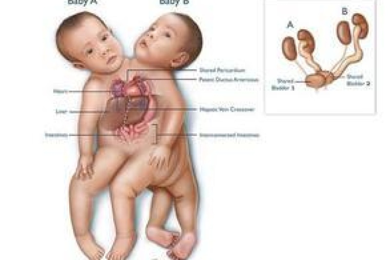 哈尔滨：3D打印技术辅助矫治“五联症”患儿