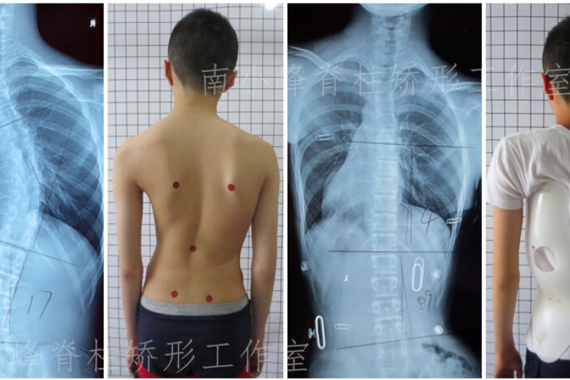 时尚舒适 中国首款3D打印脊柱侧弯支具诞生