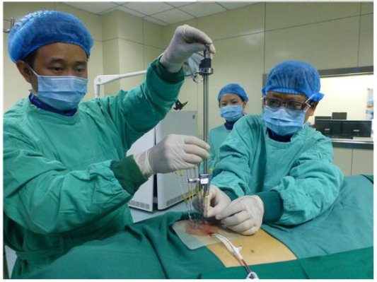 为针头“导航” 河北完成全球首例3D打印模板肺癌粒子植入术