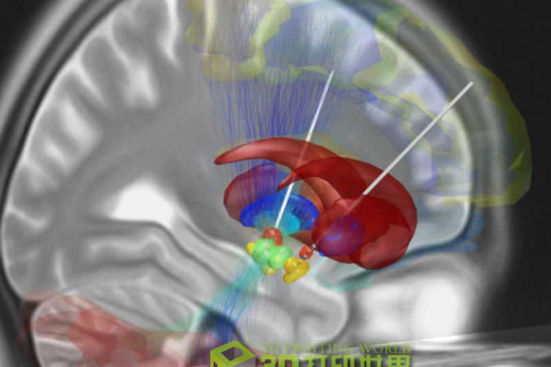 完美复制大脑 加拿大医生如何艺术地运用3D打印
