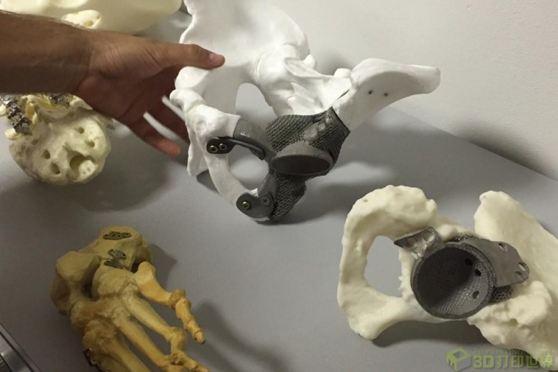 滚蛋吧骨癌君！意大利首用3D打印钛修复受损骨