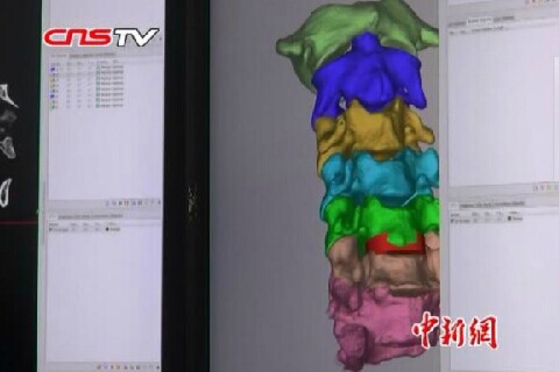 中国吉大二院完成首例3D打印颈椎手术
