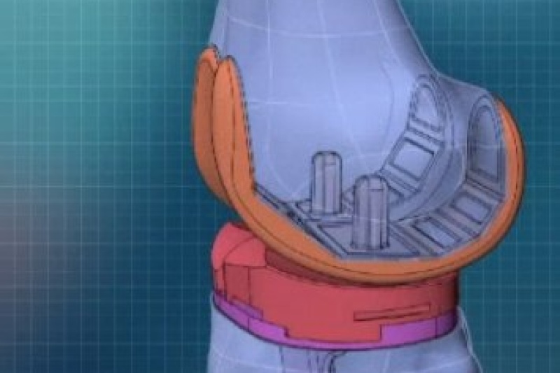 英国完成首例金属3D打印膝盖植入手术