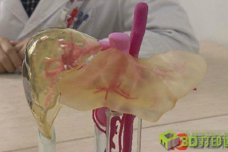 【首例】病儿太重母亲捐肝不够用 3D打印帮母子“拼肝”