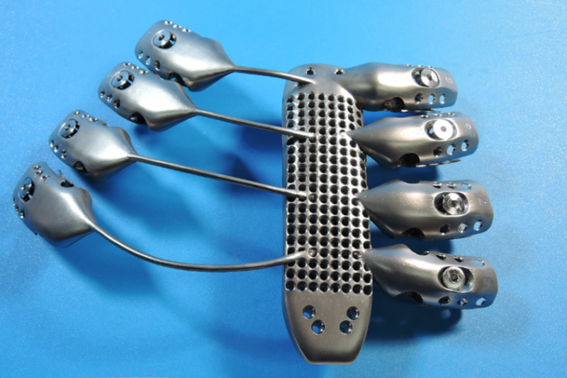 西班牙完成世界最大3D打印植入物植入手术