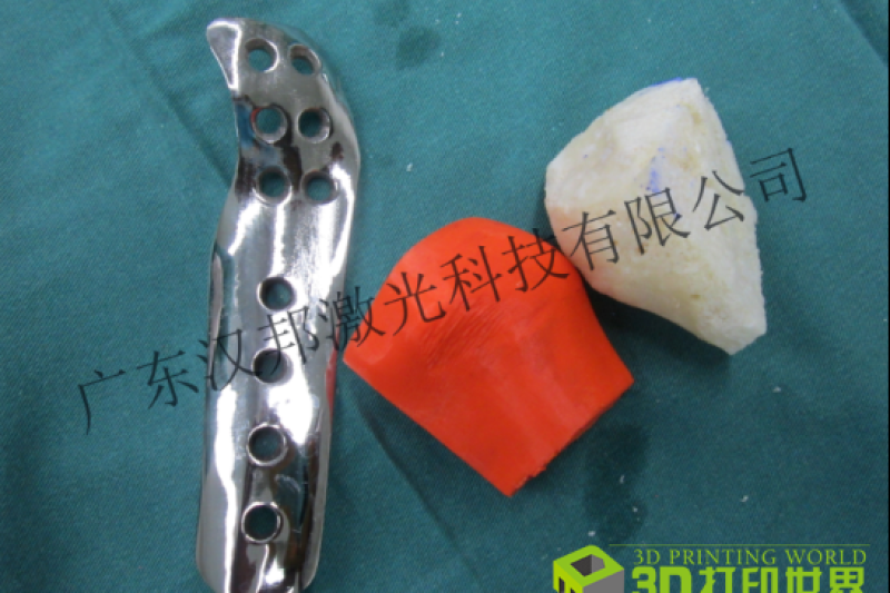 临床治疗271例 自筹经费1500万 汉邦激光抢占3D打印骨科应用先机