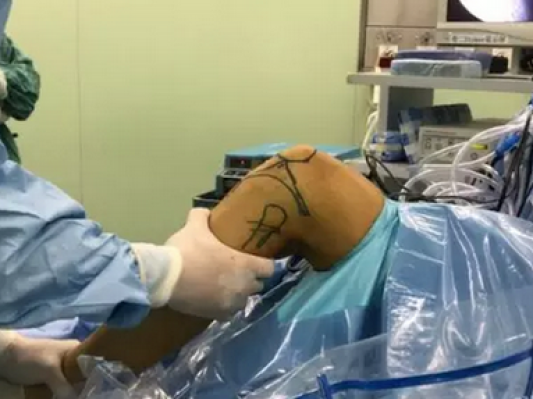 多图详解：广西医药借3D打印进行前交叉韧带返修手术