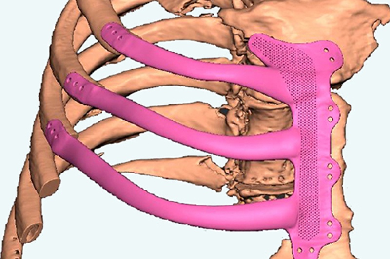 手术治疗令南威尔士癌症患者起死回生