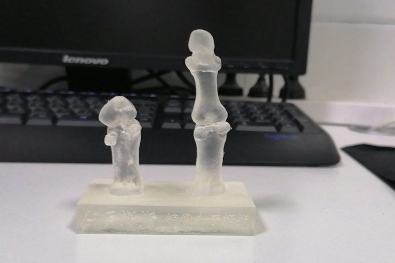 沧州首例“3D 打印拇指全形再造”手术顺利完成